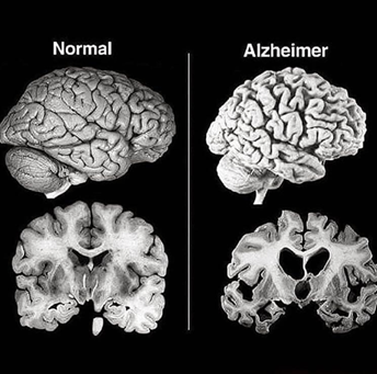 Normal Brain vs Alzheimer’s Brain